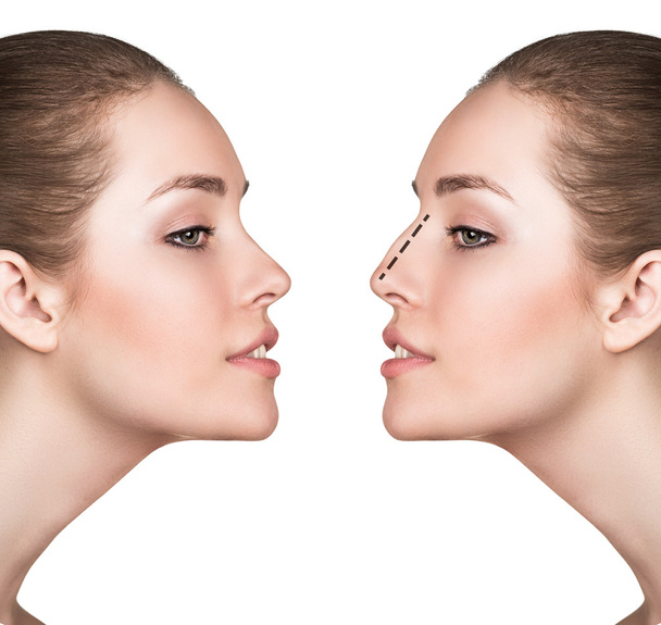 Woman before and after cosmetic nose surgery - Foto, Imagem