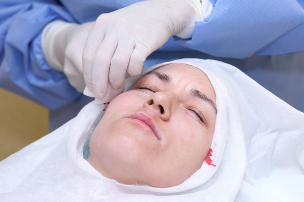 Procedure of face lifting surgery. - Photo, Image