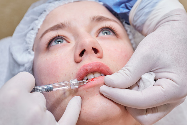 Procedure van lip injectie met filler. - Foto, afbeelding