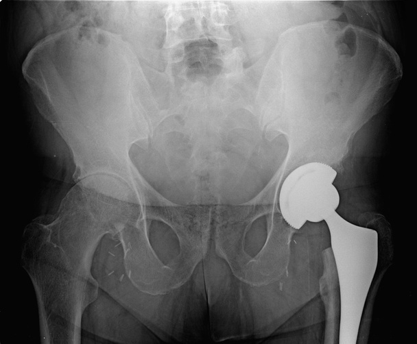 Hip Prosthesis MR, artificial device used to replace a missing b - Photo, Image