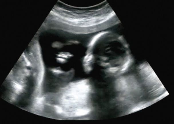 Obstetric ultraääni ultraääni ultraääni Ekografia ensimmäisen kuukauden
 - Valokuva, kuva
