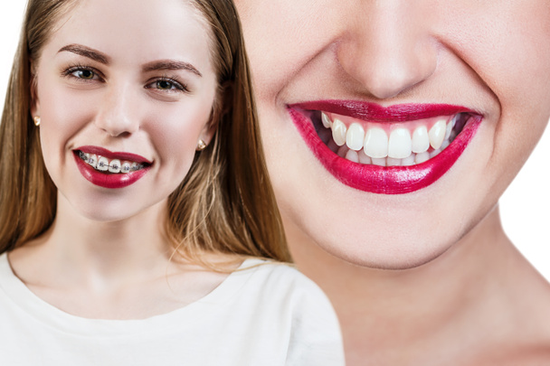 Tökéletes fogak előtt és után a fogszabályozó - Fotó, kép