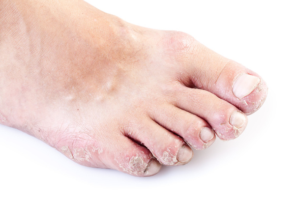 Soltero pie masculino con eczema aislado sobre fondo blanco
 - Foto, imagen