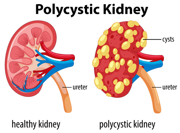 Diagram weergegeven: Polycysteuze nieren - Vector, afbeelding