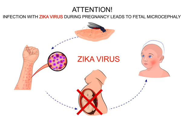 a terhes nők számára a zika vírus-fertőzés következménye - Vektor, kép