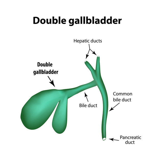 Double gall bladder. Pathology of the gallbladder. Cholecystitis. The structure of the gallbladder. Infographics. Vector illustration on isolated background - Vector, Image