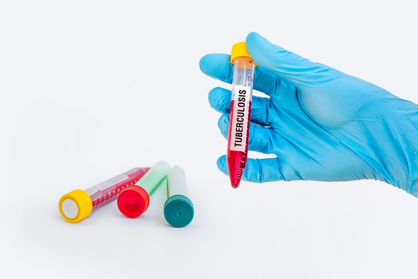 Δοκιμαστικό σωλήνα με δείγμα αίματος για τη δοκιμή φυματίωσης - Φωτογραφία, εικόνα