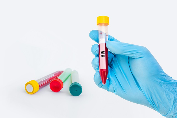 Koeputki, jossa verinäyte HIV- tai AIDS-testiä varten
 - Valokuva, kuva