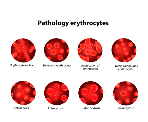Patología de los glóbulos rojos. Eritrocitos. Listos. Infografías. Ilustración vectorial sobre fondo aislado
 - Vector, imagen