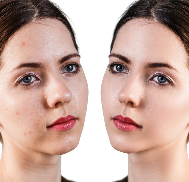 Γυναίκα με πρόβλημα δέρμα στο πρόσωπό της - Φωτογραφία, εικόνα
