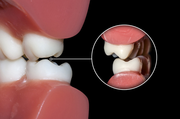dents molaires occlusion dentaire fermer
 - Photo, image