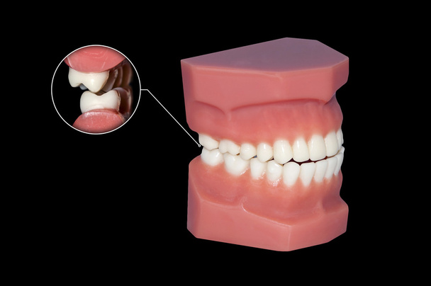 grincement de dents illustration molaires dentaires
 - Photo, image