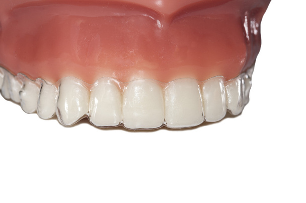 unsichtbare Zahnspangen Kieferorthopädische abnehmbare Aligner  - Foto, Bild