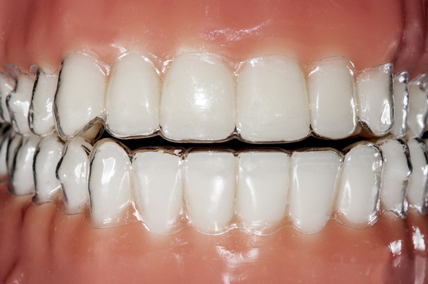 aligneurs invisibles et amovibles pour le traitement des dents
  - Photo, image