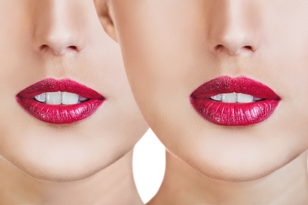 Labios rojos antes y después de las inyecciones de relleno
 - Foto, imagen