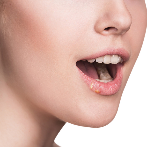 Hermosos labios infectados por el virus del herpes
 - Foto, Imagen