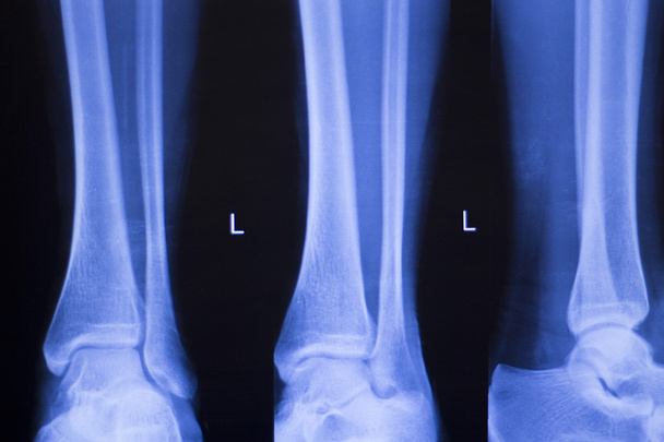 Lesión en el tobillo del pie exploración por rayos X
 - Foto, Imagen