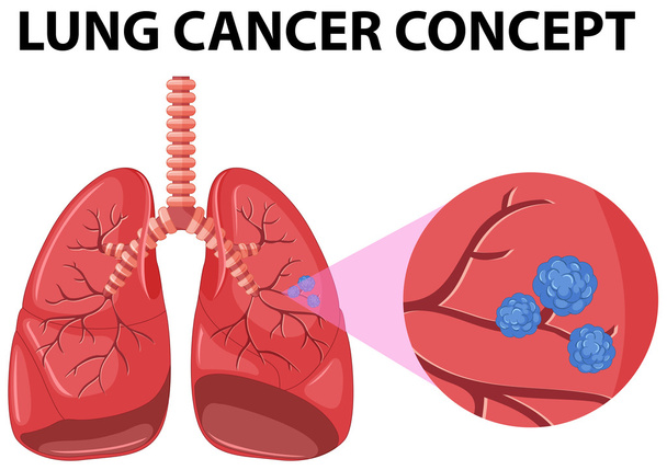Diagram of lung cancer concept - Vector, imagen