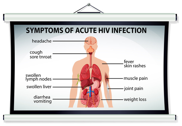 Grafiek met symptomen van acute Hiv-infectie - Vector, afbeelding