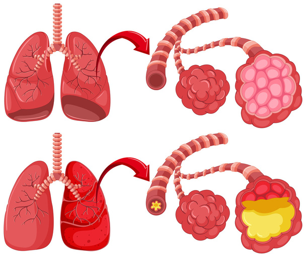 Pulmones humanos con neumonía
 - Vector, Imagen
