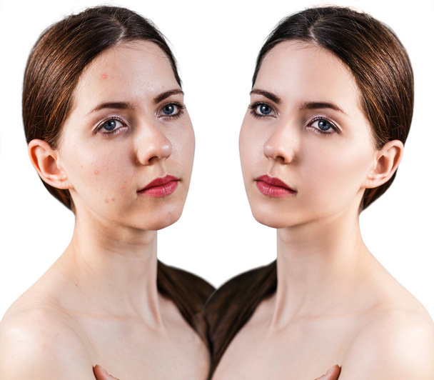 Mujer con problemas de piel en la cara
 - Foto, imagen