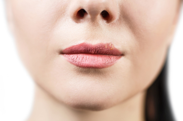 Mooie lippen besmette herpesvirus - Foto, afbeelding