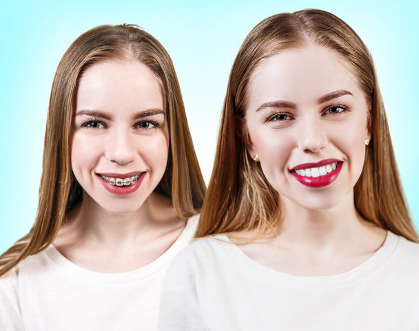 Perfect teeth before and after braces - Fotó, kép