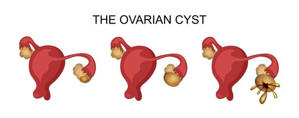 baarmoeder en eierstokken cyste - Vector, afbeelding