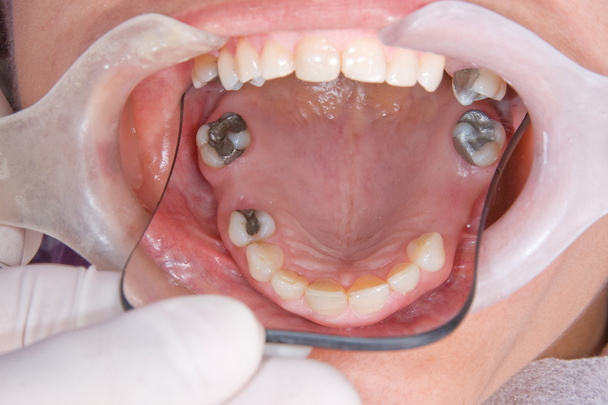 processo di fabbricazione di protesi dentarie
 - Foto, immagini