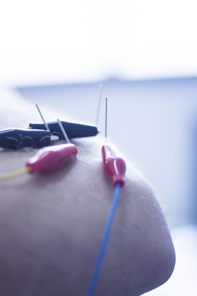 Agujas de acupuntura electroacupuntura
 - Foto, imagen