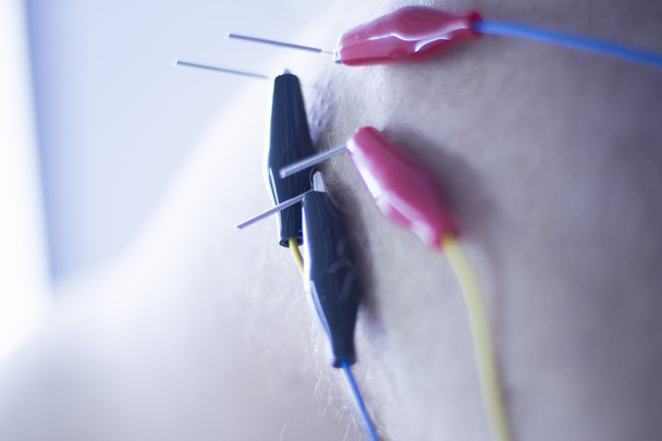 Elektroakupunktur Akupunkturnadeln - Foto, Bild