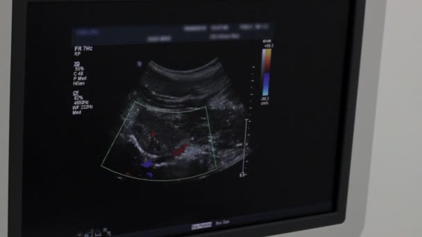 Doktor gösterileri izlemek Böbrek arteri ultrason muayenesi renk, yakın çekim - Video, Çekim