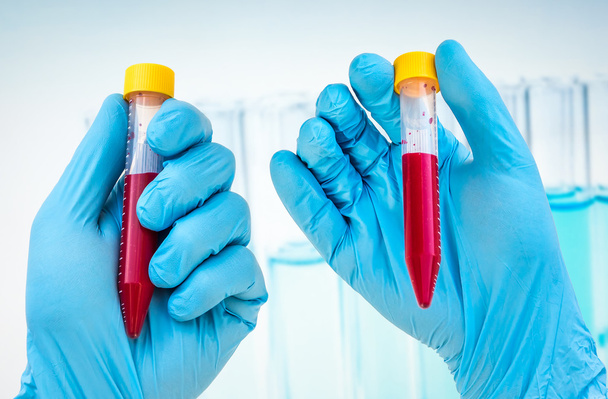 Tubo de ensayo con muestra de sangre para el análisis de sangre
 - Foto, Imagen