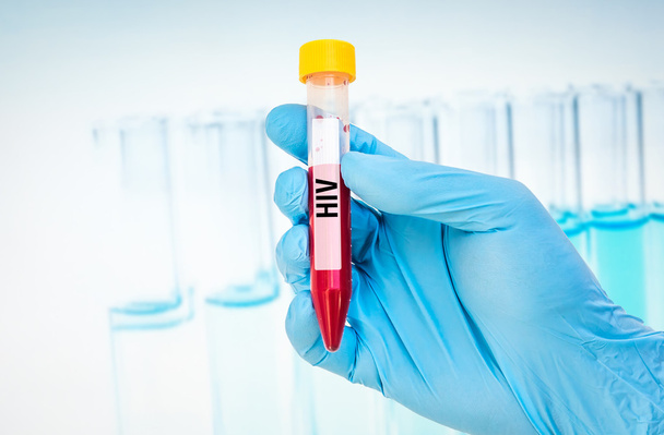 Пробірки з зразків крові на ВІЛ або СНІДом випробування - Фото, зображення