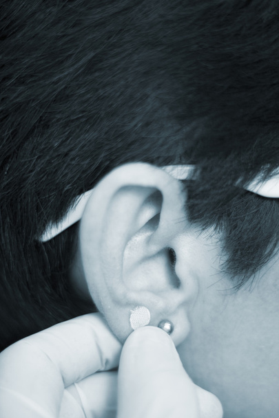 Аурикулярная терапия семенами ушей
 - Фото, изображение