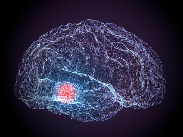 Doenças degenerativas do cérebro, Parkinson
 - Foto, Imagem