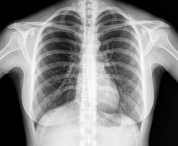 Image radiographique du thorax humain sain - Photo, image
