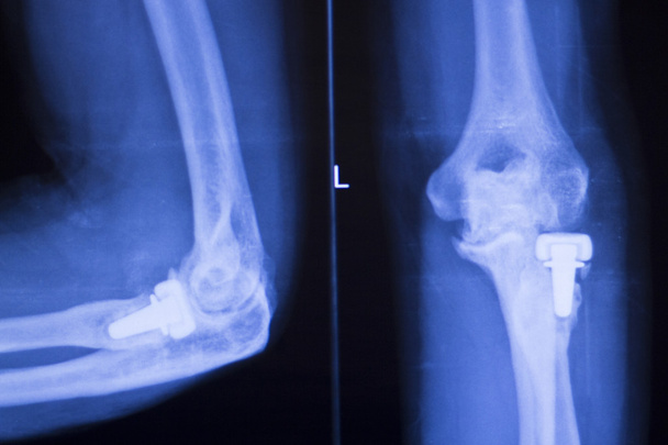Elbow joint orthopedics implant xray - Photo, Image