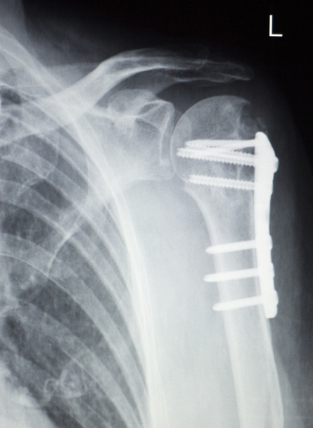 Radiografía de implante ortopédico de hombro
 - Foto, Imagen