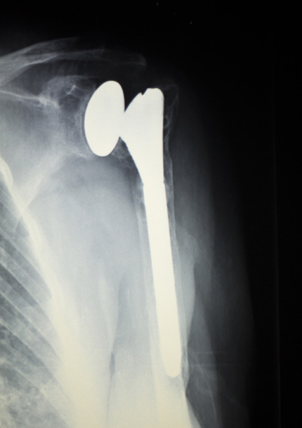 Radiografía de implante ortopédico de hombro
 - Foto, Imagen