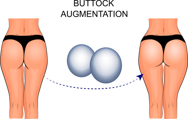 weibliche Gesäßimplantate, Po-Augmentation - Vektor, Bild