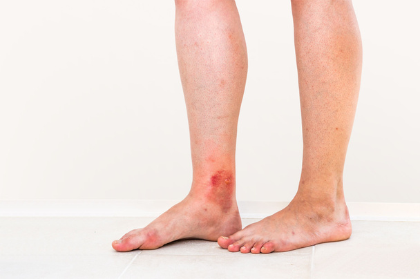Roter Hautausschlag am Bein eines Patienten, der von einem Insekt gebissen wurde - Foto, Bild