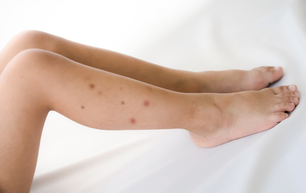 Ukąszenia komara ból na nogi dziecka - Zdjęcie, obraz
