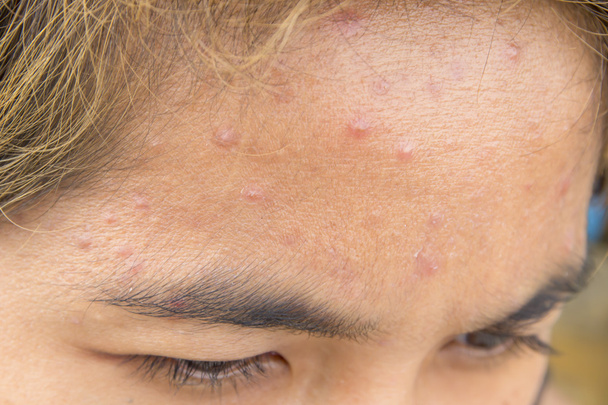  forehead with typical problem with acne  - Photo, Image