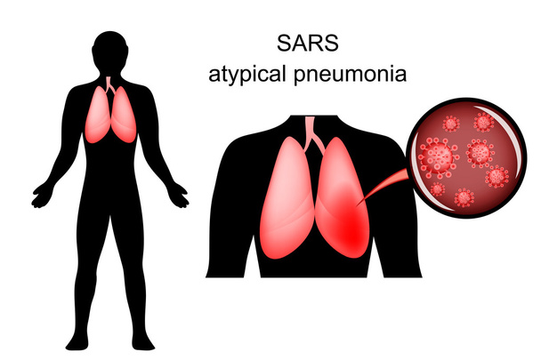 SARS. inflamed lungs and the causative agent - Vector, Image