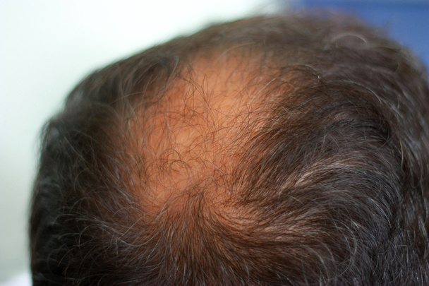 Cabeça masculina com sintomas de perda de cabelo atrás
 - Foto, Imagem