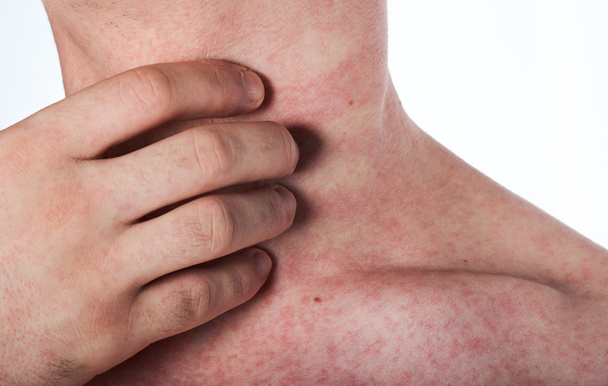 man scratching his neck with rash - Photo, Image