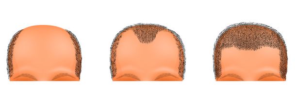 Männerkopf leidet Haarausfall. Haartransplantation - Vektor, Bild