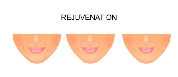reducción de arrugas alrededor de la boca. rejuvenecimiento
 - Vector, Imagen