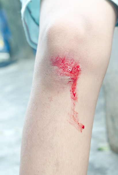 αιμορραγία ξυσθεί ανθρώπινη γόνατο μετά από πτώση από ποδήλατο - Φωτογραφία, εικόνα